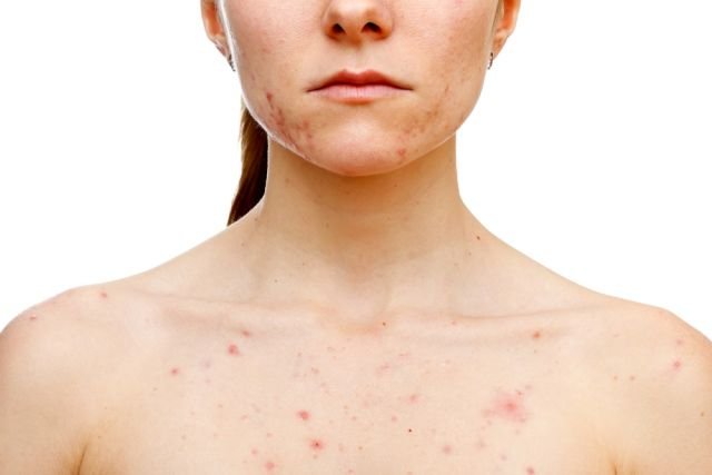 cuales-son-los-diferentes-tipos-de-acne
