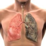 metastasis-cerebrales-por-cancer-de-pulmon