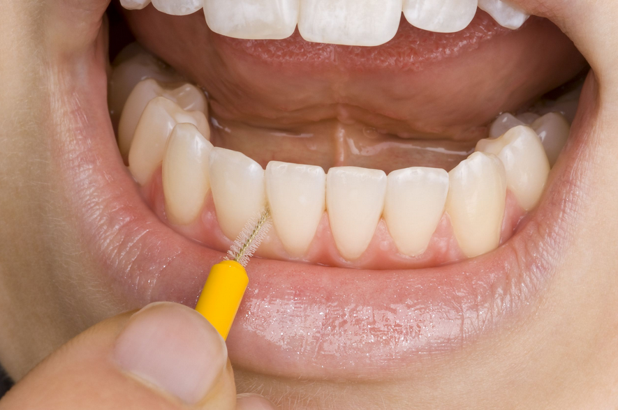 Por qué es importante limpiar y dar forma a los dientes en RCT