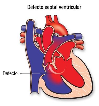 defecto-septal-ventricular