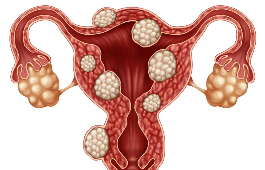 fibromas-uterinos-causas-tipos-sintomas-tratamiento