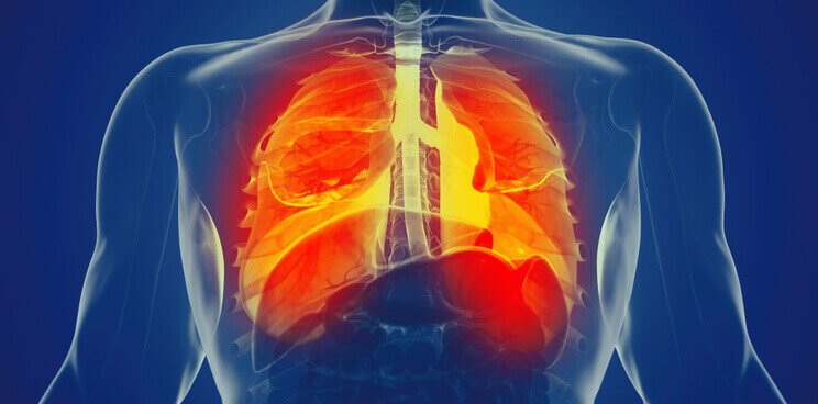formas-de-empoderar-a-los-pacientes-que-tienen-hipertension-pulmonar