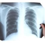 tuberculosis-tb-causa-sintomas-tratamiento-y-prevencion