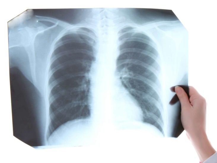 tuberculosis-tb-causa-sintomas-tratamiento-y-prevencion