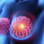 cancer-de-mama-causas-sintomas-tratamientos-y-remedios