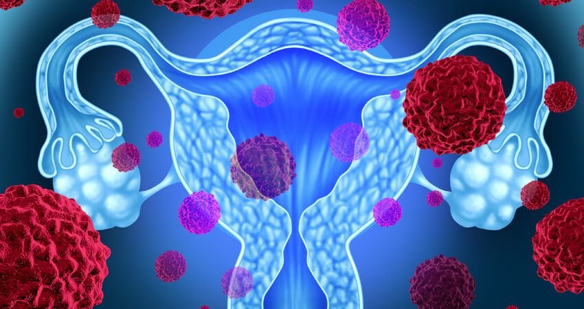 cancer-de-ovario-causa-sintomas-factores-de-riesgo-prevencion