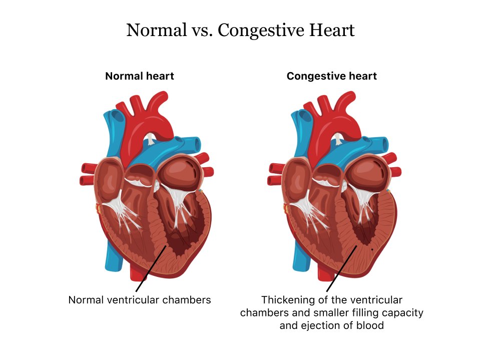 cuidado-con-estos-sintomas-de-insuficiencia-cardiaca-congestiva