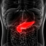 el-cancer-de-pancreas-causa-sintomas-tratamiento-y-prevencion