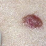 el-melanoma-causa-sintomas-de-melanoma-maligno