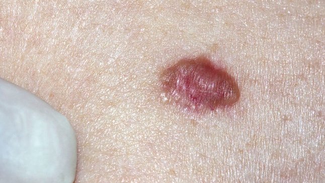 el-melanoma-causa-sintomas-de-melanoma-maligno