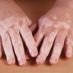 el-vitiligo-causa-sintomas-tratamientos-remedios-caseros