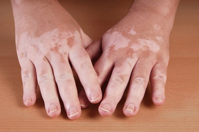 el-vitiligo-causa-sintomas-tratamientos-remedios-caseros