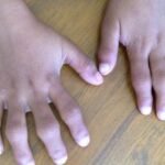 la-artritis-reumatoide-juvenil-causa-sintomas-remedios-caseros