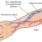 la-fistula-arteriovenosa-causa-sintomas-y-tratamiento