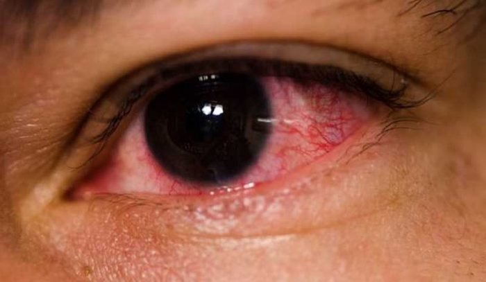 ojos-rojos-causa-sintomas-diagnostico-tratamiento