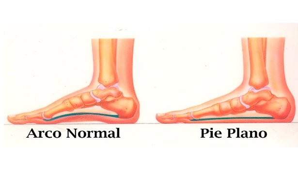 pies-planos-pie-plano-causas-sintomas-tratamiento