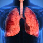 sintomas-de-fibrosis-pulmonar-causas-tratamiento