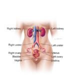 sintomas-de-obstruccion-ureteral-causas-tratamiento