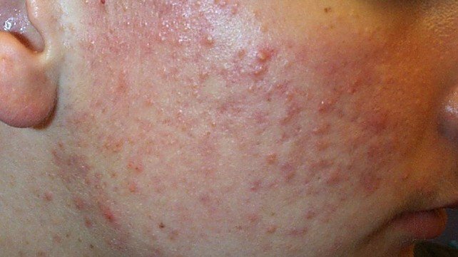 tipos-de-afecciones-de-la-piel-del-acne-causas-tratamiento-prevencion