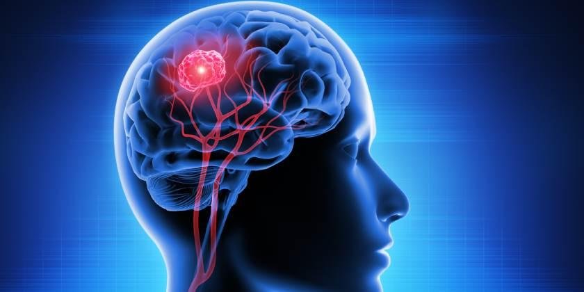 tumor-cerebral-causas-sintomas-tratamientos-y-prevencion